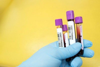 Simple blood test can detect two out of three cancers, trial by Britain’s NHS finds